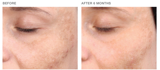 nimue-transformation-1 Nimue Skin Technology Treatment