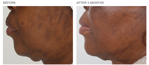 nimue-transformation-2 Nimue Skin Technology Treatment