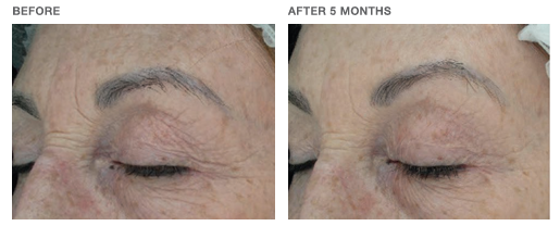 nimue-transformation-3 Nimue Skin Technology Treatment