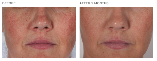 nimue-transformation-5 Nimue Skin Technology Treatment