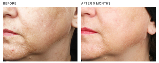 nimue-transformation-6 Nimue Skin Technology Treatment
