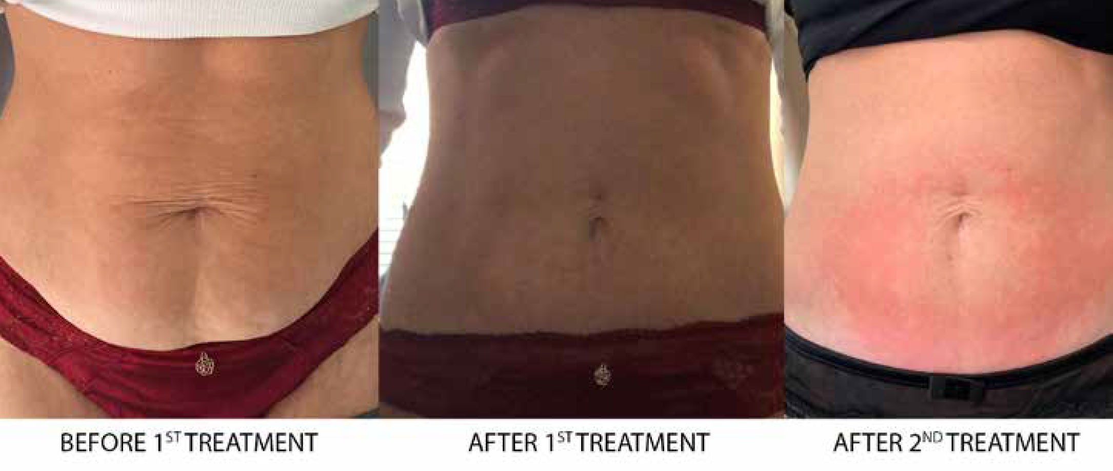 collagen-lifting-results-2 Collagen Lift Results