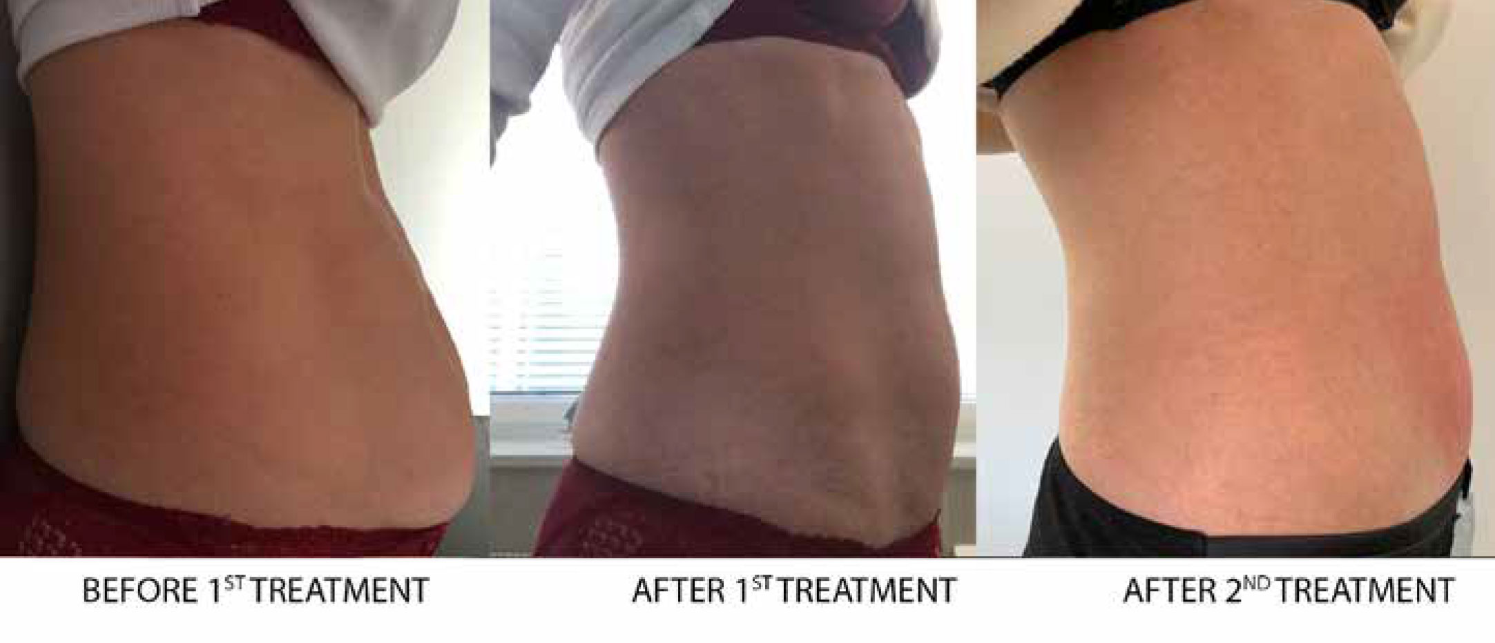 collagen-lifting-results-3 Collagen Lift Results
