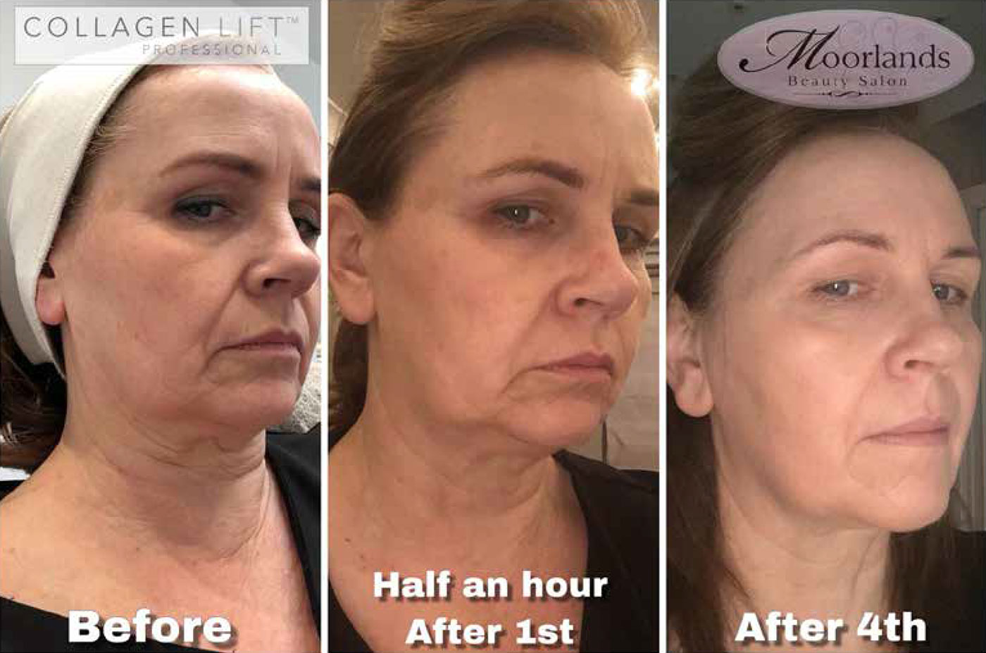 collagen-lifting-results-4 Collagen Lift Results
